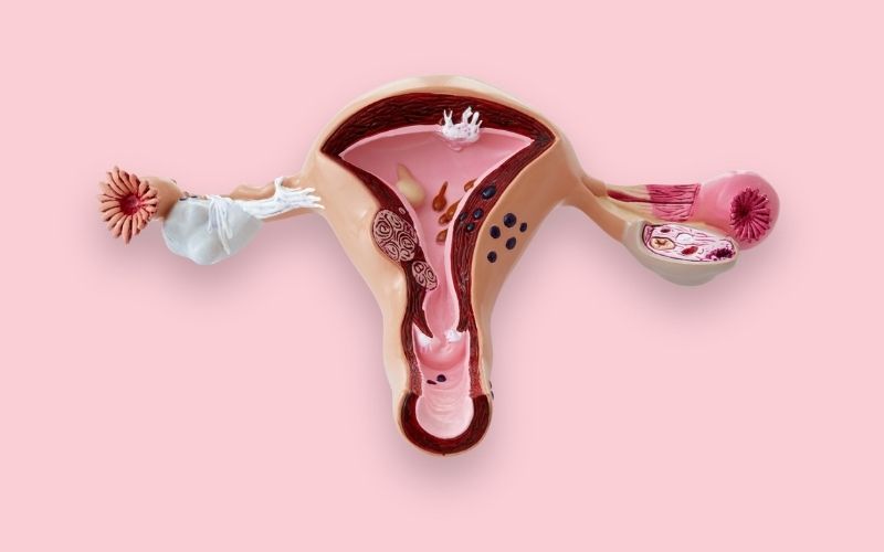 Phụ nữ bị hội chứng buồng trứng đa nang có con được không?