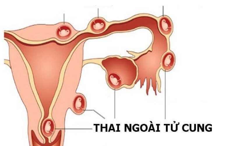 Thai ngoài tử cung có thể gây nguy hiểm cho mẹ bầu. (Ảnh: Sưu tầm Internet)
