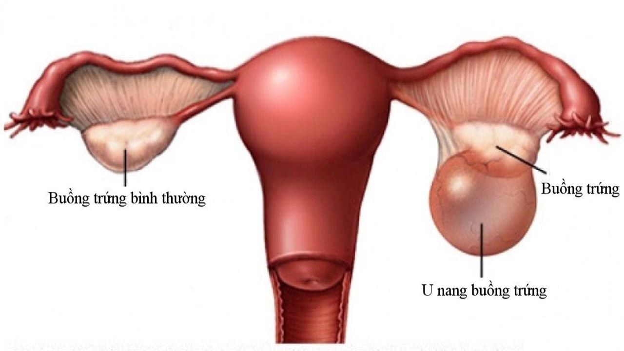 Đau bụng dưới ở tuần 32 có thể là dấu hiệu của bệnh nang buồng trứng. (Ảnh: Sưu tầm Internet)