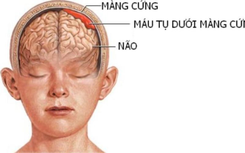 Tụ máu não là một chấn thương không hề nhẹ và có thể sẽ phải phẫu thuật để lấy khối máu tụ trong não (Ảnh: Sưu tầm internet)