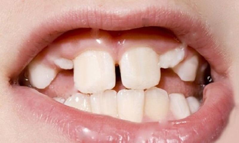Trẻ bị đứt dây chằng môi trên khi bị té ngã có nguy hiểm hay không  (Nguồn: Sưu tầm Internet)