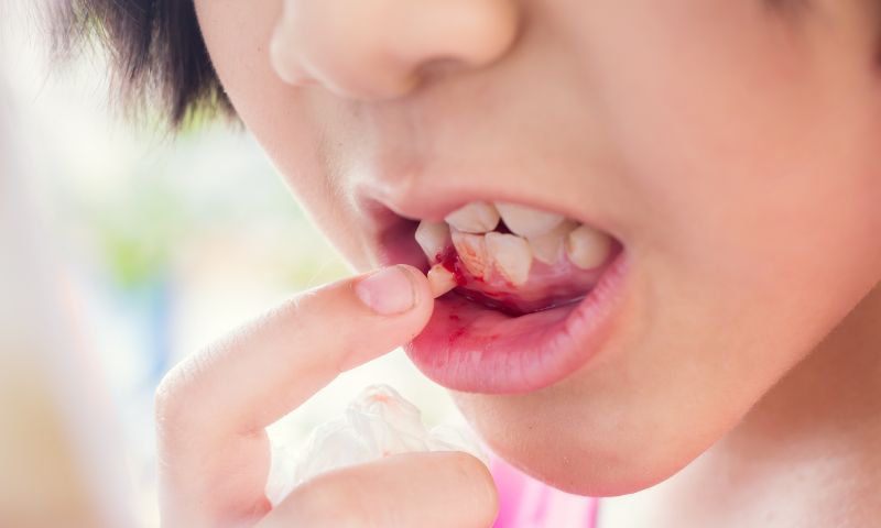 Trẻ bị ngã gãy răng vĩnh viễn cần làm gì? (Ảnh: Nguồn Internet)