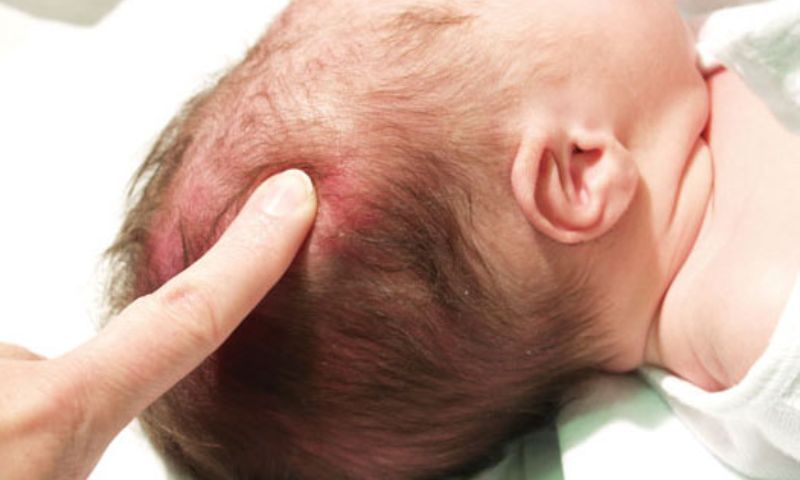 Trẻ nhỏ bị ngã có dấu hiệu tụ máu dưới da đầu. (Ảnh: Nguồn Internet)