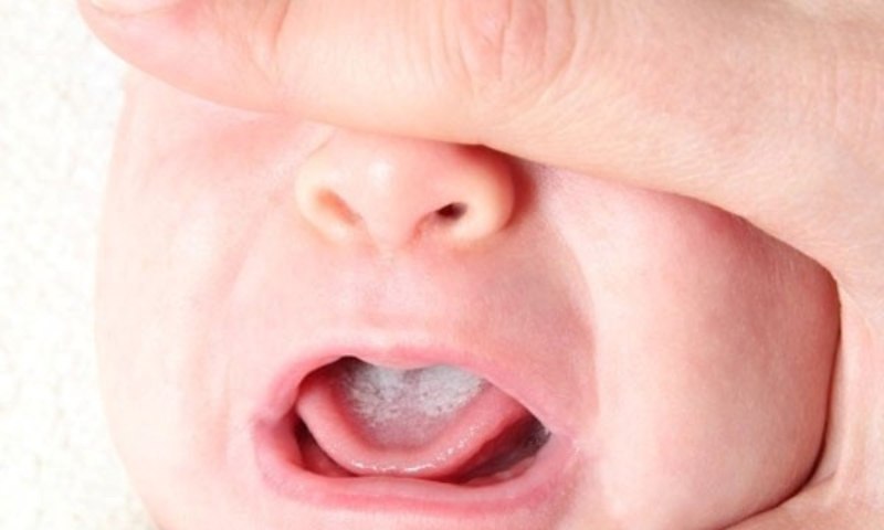 Những dấu hiệu giúp bố mẹ biết trẻ đang bị bỏng môi, lưỡi (Nguồn: Sưu tầm Internet)