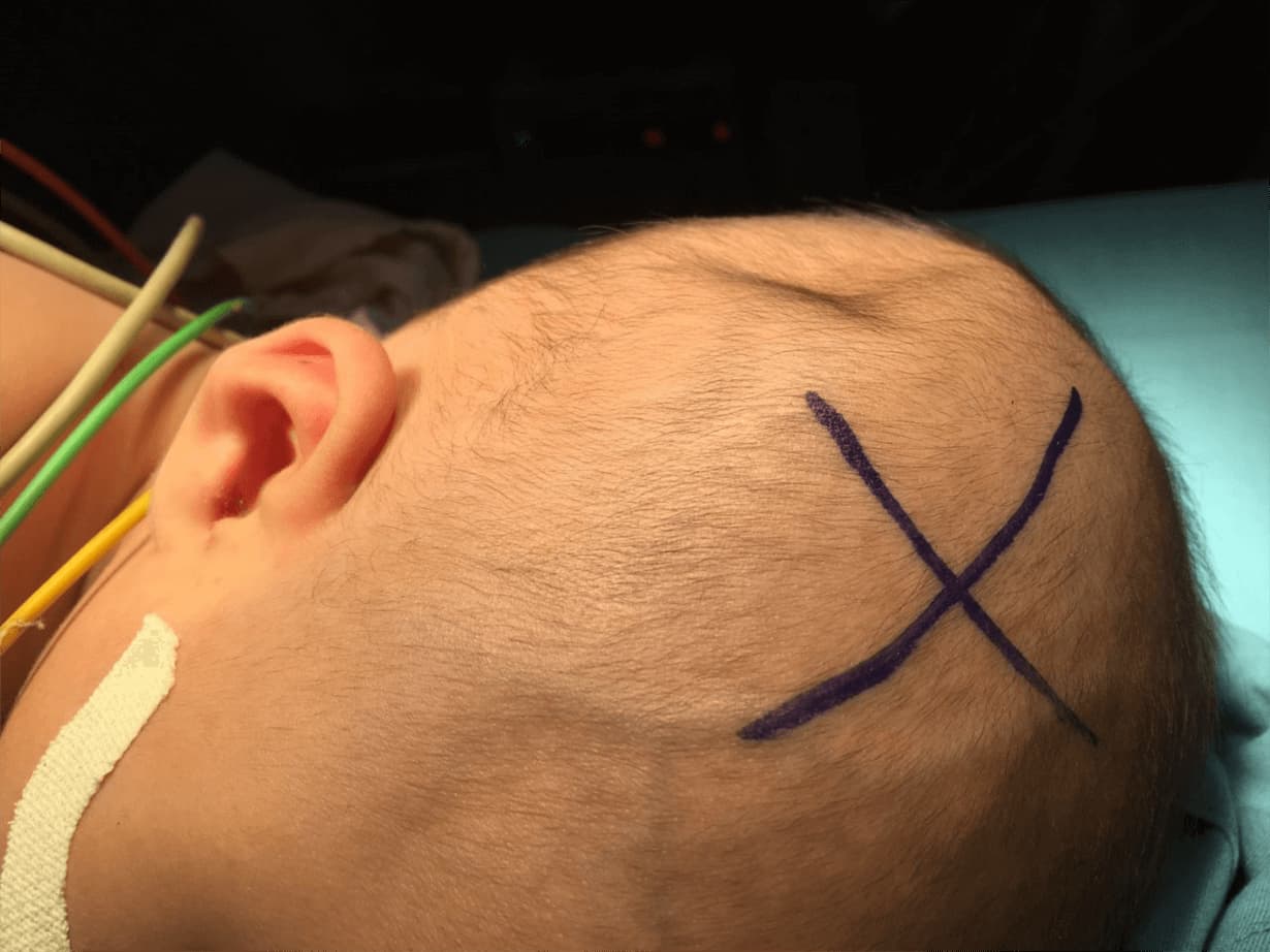 Trẻ bị ngã đập đầu có thể dẫn đến biến chứng về thần kinh và tri giác sau này (Ảnh: Sưu tầm internet)