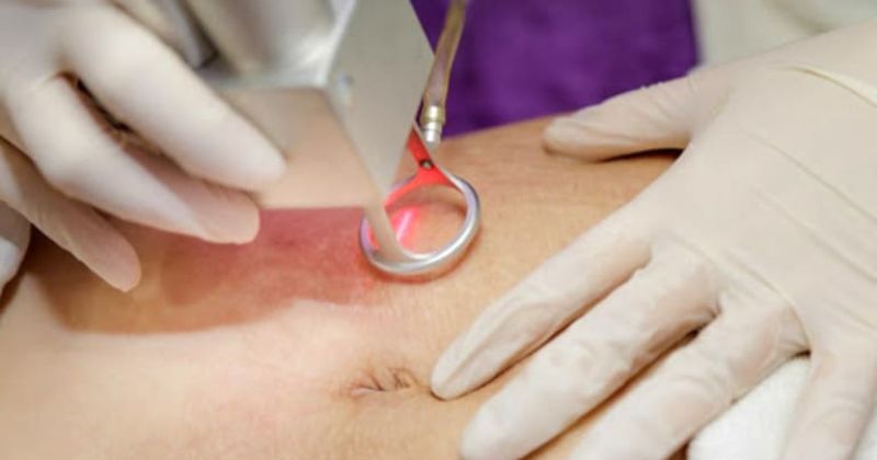 Điều trị rạn da sau sinh bằng laser giúp làn da được săn chắc, mờ rạn (Ảnh: Sưu tầm Internet)