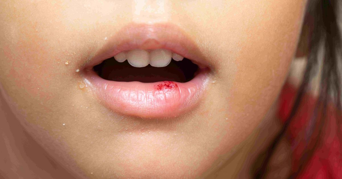 Trẻ bị ngã sưng môi phải làm sao? Các mẹo làm giảm sưng môi cho trẻ