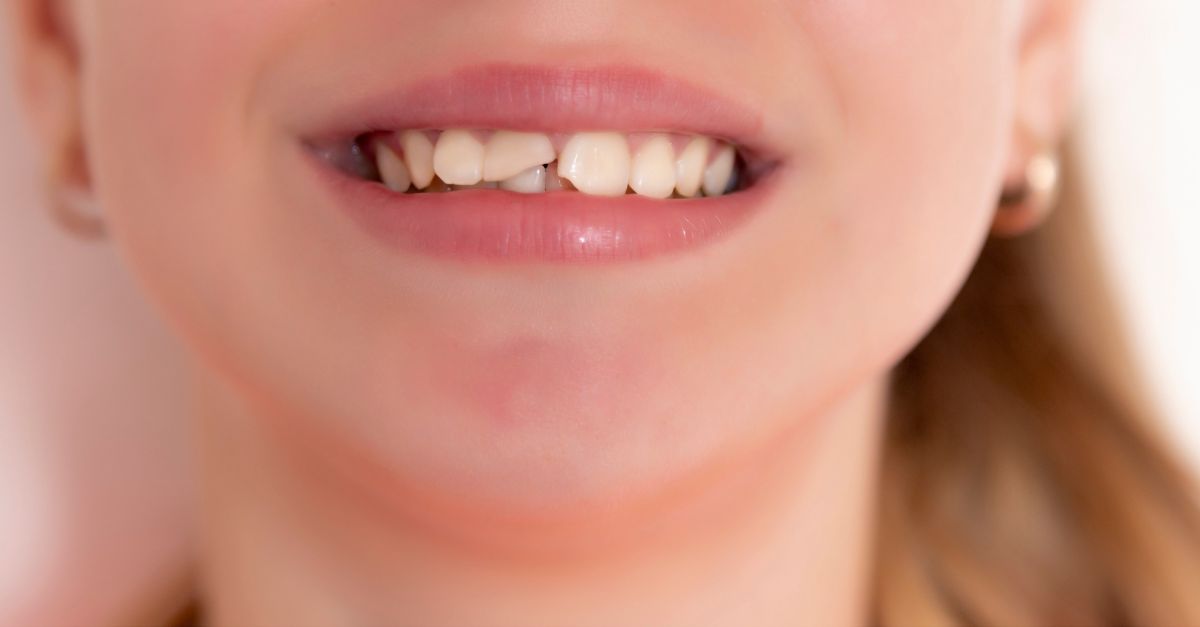 Trẻ bị ngã mẻ răng vĩnh viễn cần xử lý thế nào?