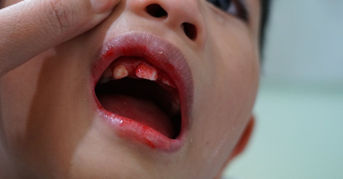  Rách môi trong miệng : Làm sao để chăm sóc và khắc phục tình trạng này?