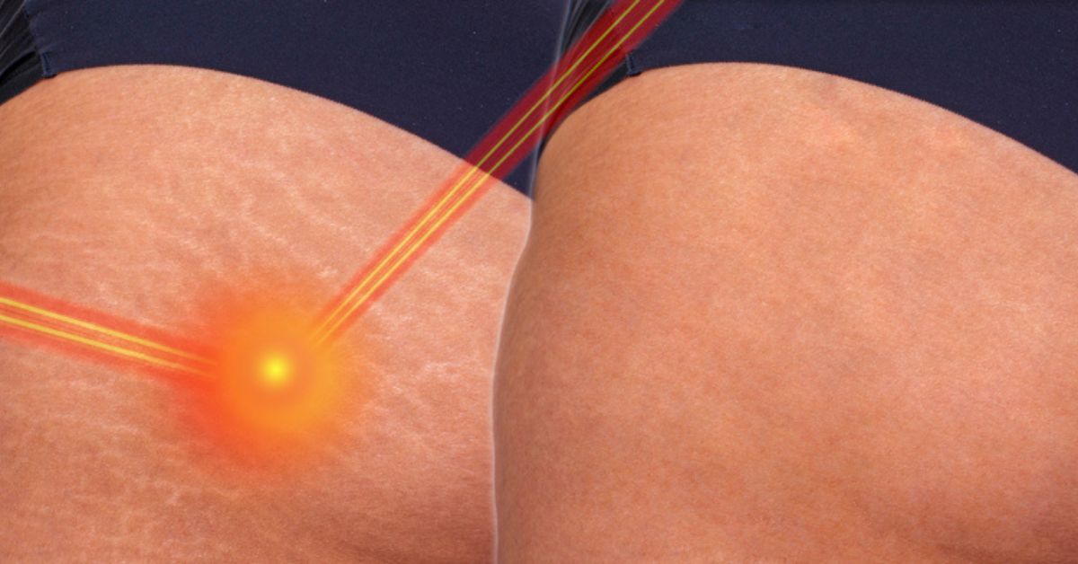 Trị rạn da sau sinh bằng laser có hiệu quả và an toàn không?