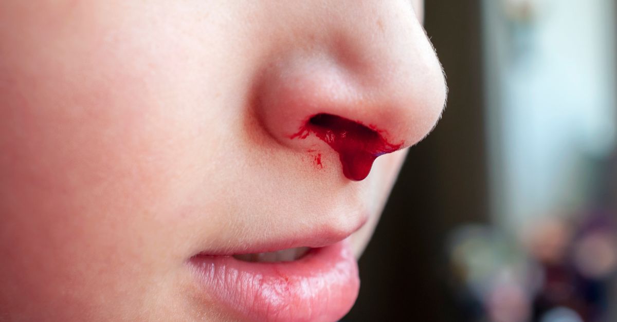Cách xử lý ngay lập tức khi gặp trường hợp chảy máu mũi sau ngã đập đầu?
