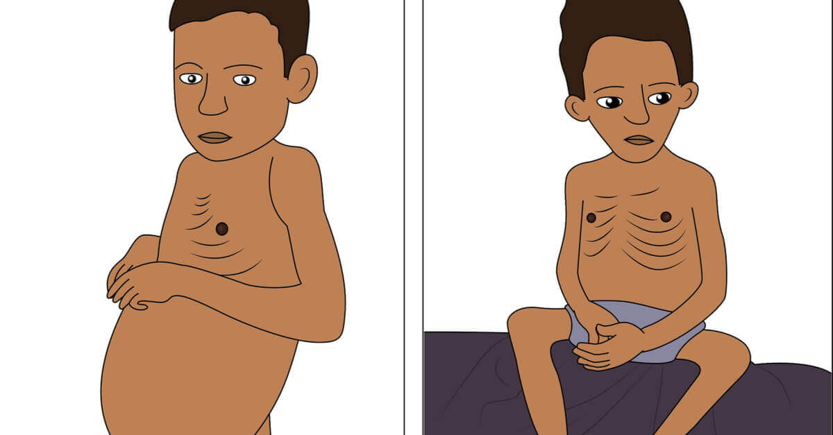 Cách nhận biết suy dinh dưỡng thể phù (Kwashiorkor) ở trẻ