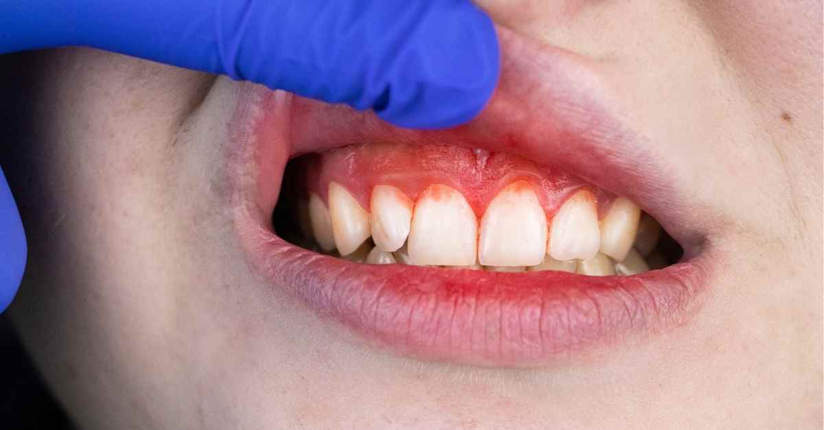 Cha mẹ nên làm gì khi trẻ bị ngã chảy máu răng
